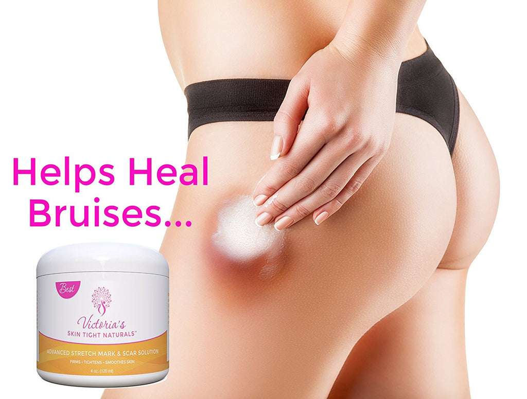thighs legs hips and butt Best Stretch Marks Removal Cream, Prevent & Reduce Marks