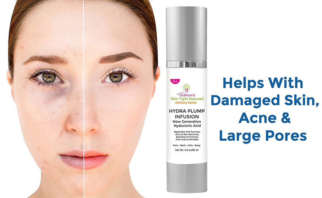 hyaluronic acid helps with acne and large pores and builds collagen 