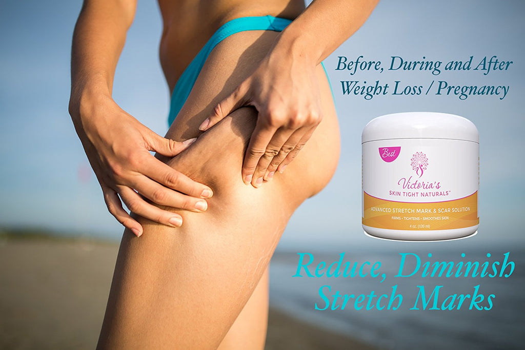 get rid of stretch marks from legs arms thighs  wieght loss and pregnancy