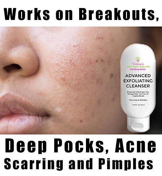 GLycolic Acid, Burdock, Kojic Acid, brightening Advanced Exfoliating Cleanser For Cystic  Acne Pimples Breakouts Wrinkles and Anti-Aging