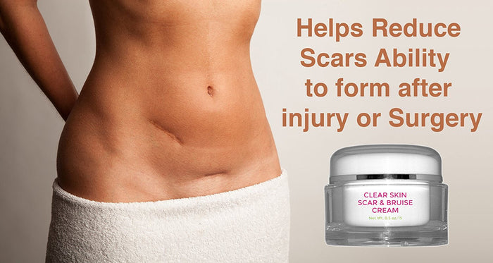 Scar and bruise cream for skin